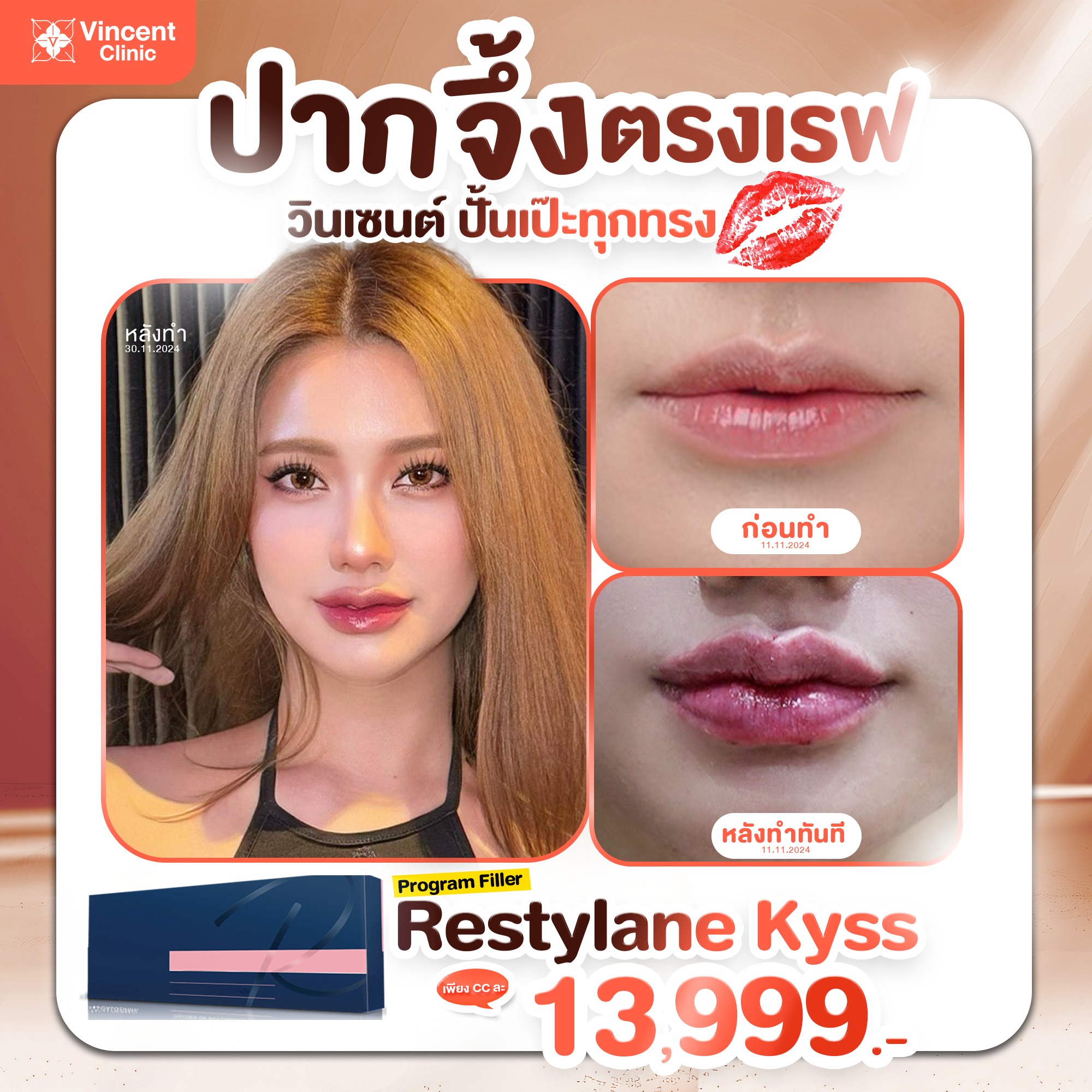 Restylane Kyss